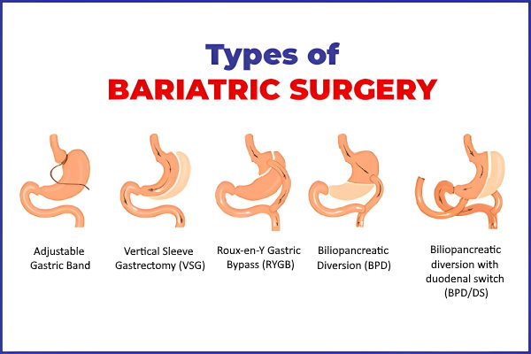 types-of-bariatric-surgery-understand-your-weight-loss-options
